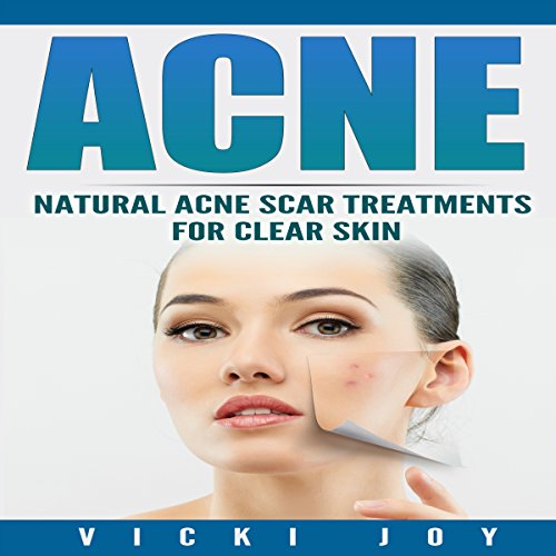 Cover of Acne