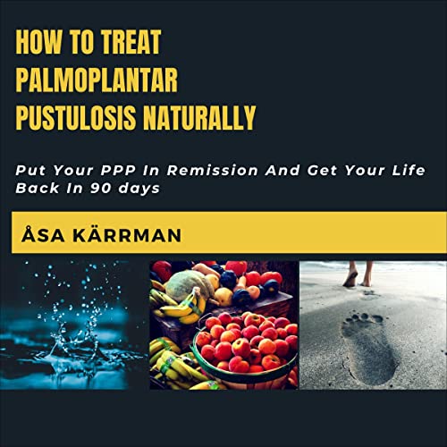 Cover of How to Treat Palmoplantar Pustulosis Naturally