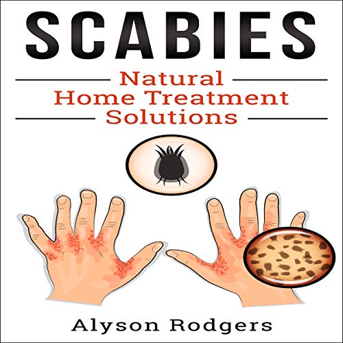 Cover of Scabies Natural Home Treatment Solution