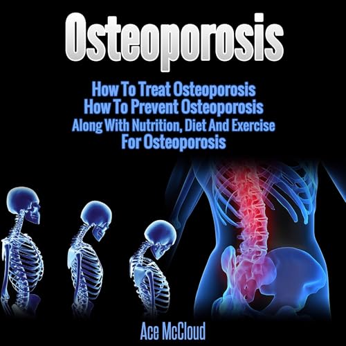 Cover of Osteoporosis: How to Treat Osteoporosis