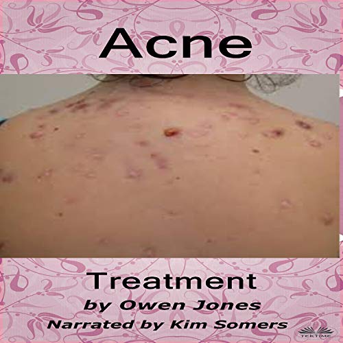 Cover of Acne Treatment: How To...
